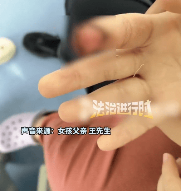家长称7岁女儿被汗血宝马咬掉手指前端，“一辈子带点残缺”，景区回应：X光显示未伤及骨头，已先行支付10万